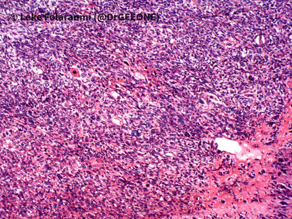 DrGeeONE's tweet photo. 1/2
Nephrectomy specimen from a young adult female who presented with haematuria, abdominal pain and loss of weight
Kindly share your opinions
-Case shared with me by my colleagues @rafiu1433 @EhizDr
#GuPath
cc: @AMubeen_Path @nucleololailo @TheKarenPinto @padmapathology1 https://t.co/5QMzgBg6cY