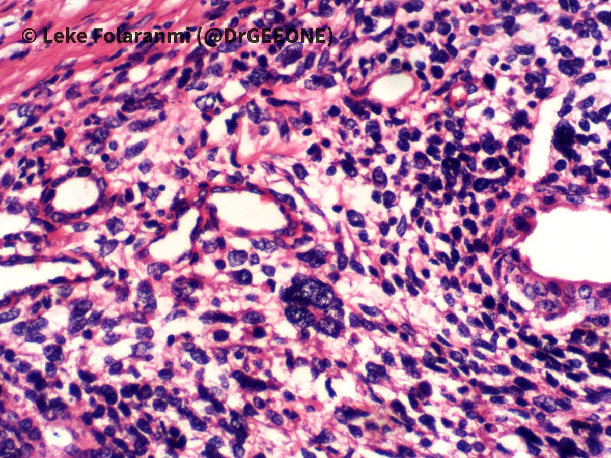 DrGeeONE's tweet photo. 1/2
Nephrectomy specimen from a young adult female who presented with haematuria, abdominal pain and loss of weight
Kindly share your opinions
-Case shared with me by my colleagues @rafiu1433 @EhizDr
#GuPath
cc: @AMubeen_Path @nucleololailo @TheKarenPinto @padmapathology1 https://t.co/5QMzgBg6cY