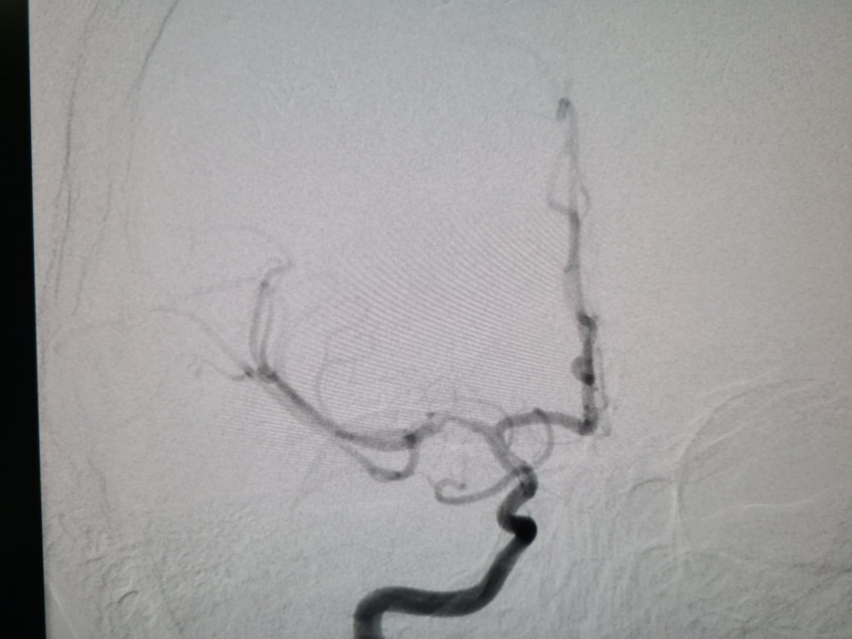 EAMDMD's tweet photo. Frustrating that #moyamoya pts often shuffled around b4 being referred for #revascularization. Its a PROGRESSIVE steno-occlusive disease & #stamca #bypass prevents further ischemia. Looking forward to publishing our 10yr #doublebarrell data. @visishs @PeterKa80460001 @moyamoyafdn https://t.co/GqLmmZ2Tpo