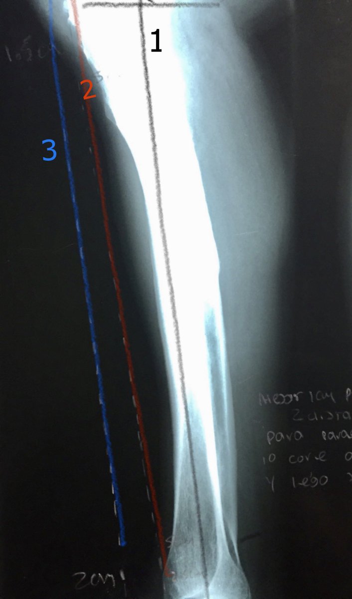 1-Line tibial axis2-Line anterior cortex proximal and distal3-Line a parallel line to 1Distance proximal and distal from 2&3 is what u need to adjust guide to be really parallel(Here1.5cm prox 2cm distal) @OrthoFolks  @JArthroplasty  @EdinburghKnee  @jointdocShields  @NaanDerthaal