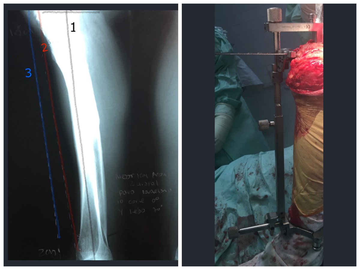 1-Line tibial axis2-Line anterior cortex proximal and distal3-Line a parallel line to 1Distance proximal and distal from 2&3 is what u need to adjust guide to be really parallel(Here1.5cm prox 2cm distal) @OrthoFolks  @JArthroplasty  @EdinburghKnee  @jointdocShields  @NaanDerthaal