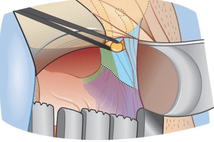 IJGConline's tweet photo. "Modification of Dargent’s radical vaginal #trachelectomy to facilitate ureteral dissection: description of technique"
Click link for article & description of technique. ⬇️
https://t.co/dAlgYqRXrX
#Surgery #Gynecology #Cancer @GynMe4 @me4_so @IJGCfellows https://t.co/dP8CPToG5v