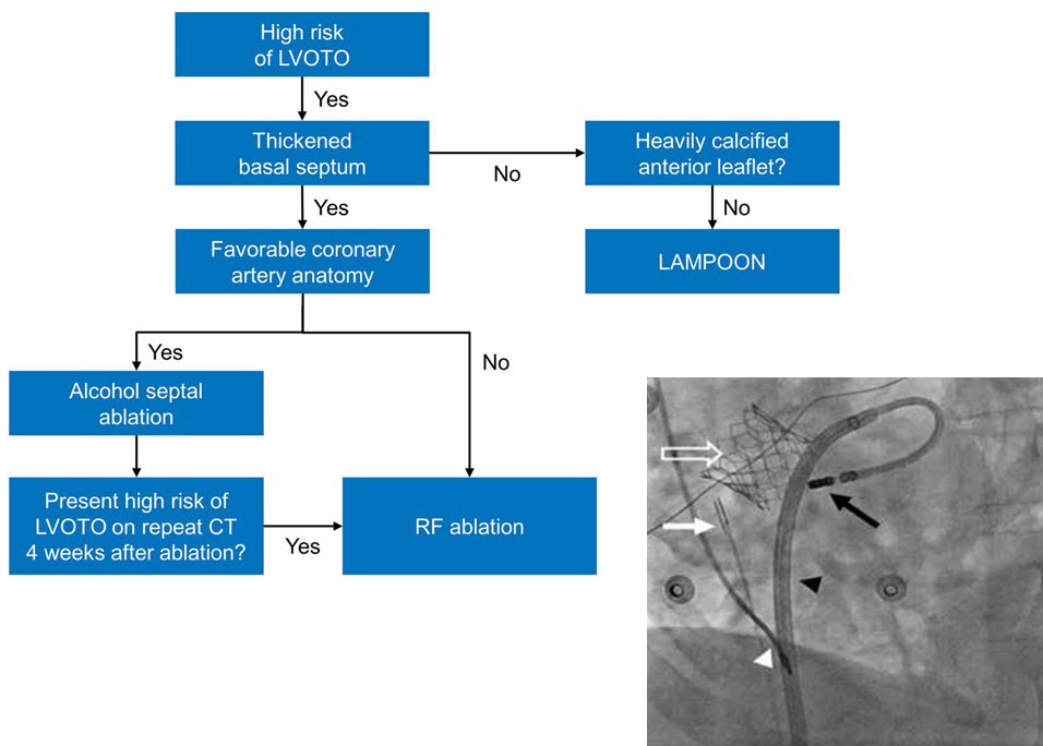 Incorporating the RADIO-TMVR technique into a simplified algorithm to mitigate the risk of LVOT obstruction after TMVR onlinelibrary.wiley.com/doi/abs/10.111… @akillumd @MayraGuerreroMD