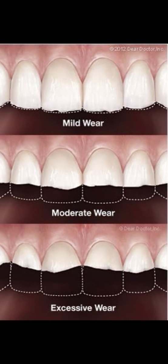 You either have: pain symptoms that you’ve normalized , Damaging your teeth ( missing teeth, Root canals, GRINDING / teeth slowly becoming “shorter” ) or a combination of both. Your teeth are not supposed to straight all the way across!!!! You are chipping your teeth away!