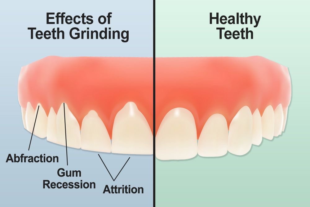 You either have: pain symptoms that you’ve normalized , Damaging your teeth ( missing teeth, Root canals, GRINDING / teeth slowly becoming “shorter” ) or a combination of both. Your teeth are not supposed to straight all the way across!!!! You are chipping your teeth away!