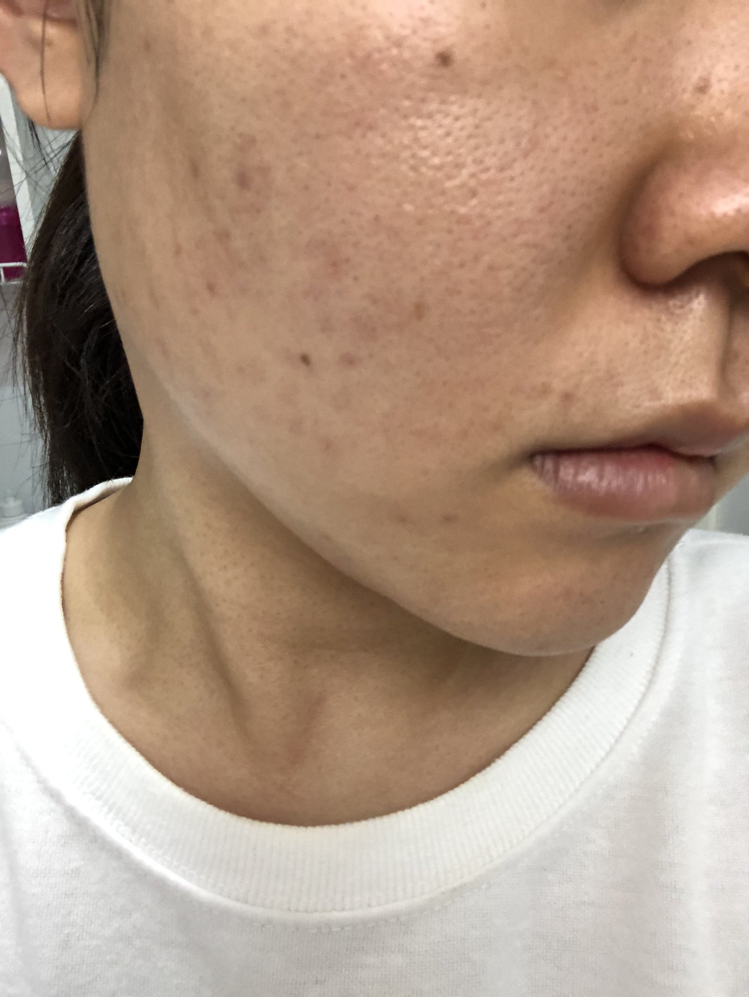 はむ Mimitan ベビオ洗顔はじめて4ヶ月 悩んでいたニキビが目立たなくなってきて 小鼻の角栓 がにょきにょき無くなった 鼻横の頬 にある黒い点にも悩んでいたのが 毛だというのに気づけたのはベビオ洗顔でティッシュオフした時に毛が抜けたから