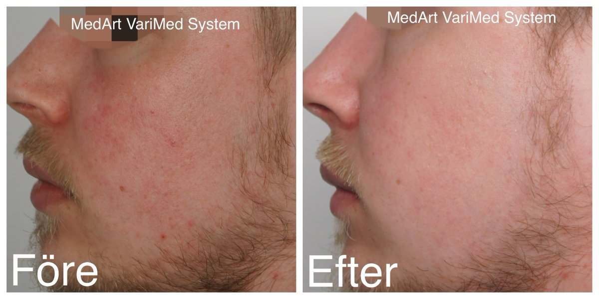 a_medart's tweet photo. Laser Treatment of Rosacea by MedArt VariMed @doctorryskinclinic. MedArt VariMed is Danish high quality complete system includes 
MedArt diode laser ✔️
MedArt Scanner ✔️
MedArt cooling system ✔️
A versatile system for hair removal and vascular lesions. #rosacea #dermatologist https://t.co/yDja52JLoH