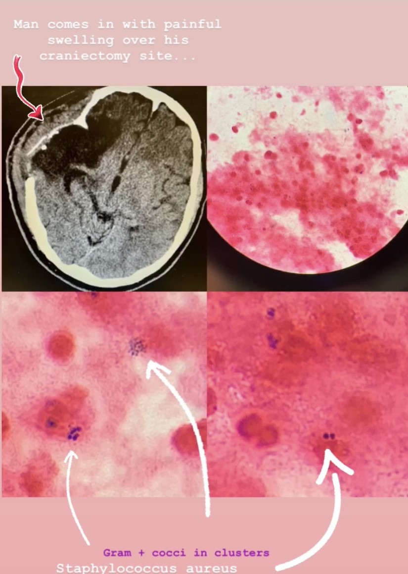 Staph aureus continues to be a formidable pathogen! @AkamineMD @PrathitKulkarni @JillWeather #IDMedEd #IDTwitter #RespectTheStaph