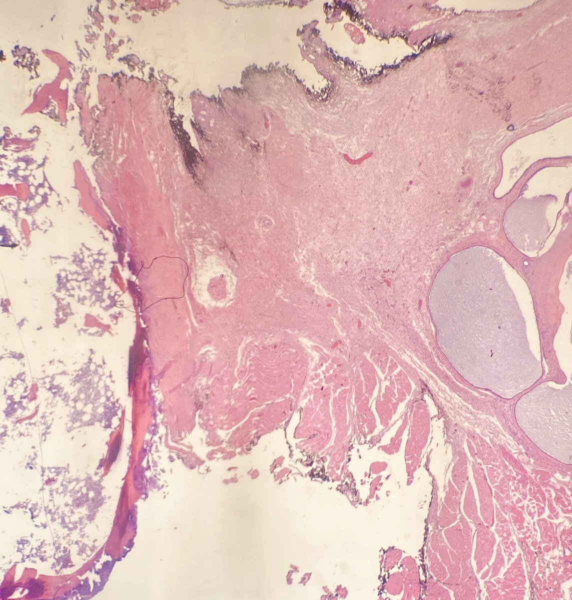 martinwpath's tweet photo. Excision of a thyroglossal duct cyst attached to hyoid bone. Micro showed multilocular cyst lined by respiratory epithelium with adjacent thyroid follicular tissue and inflammation. https://t.co/a3S74VGabr
