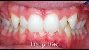 Have you been told you have a “Deep Bite”? YOU ARE OVERCLOSED. Your upper&lower jaws are misaligned. Your upper front teeth may excessively overlap the lower teeth, and the lower teeth may bite into the roof of your mouth.