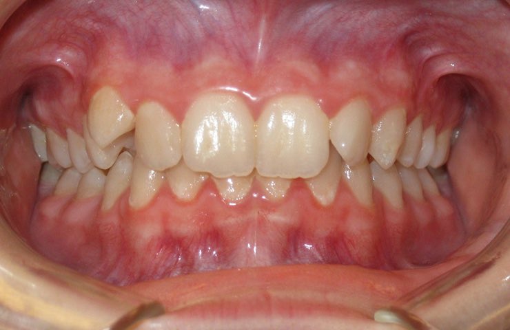 Have you been told you have a “Deep Bite”? YOU ARE OVERCLOSED. Your upper&lower jaws are misaligned. Your upper front teeth may excessively overlap the lower teeth, and the lower teeth may bite into the roof of your mouth.