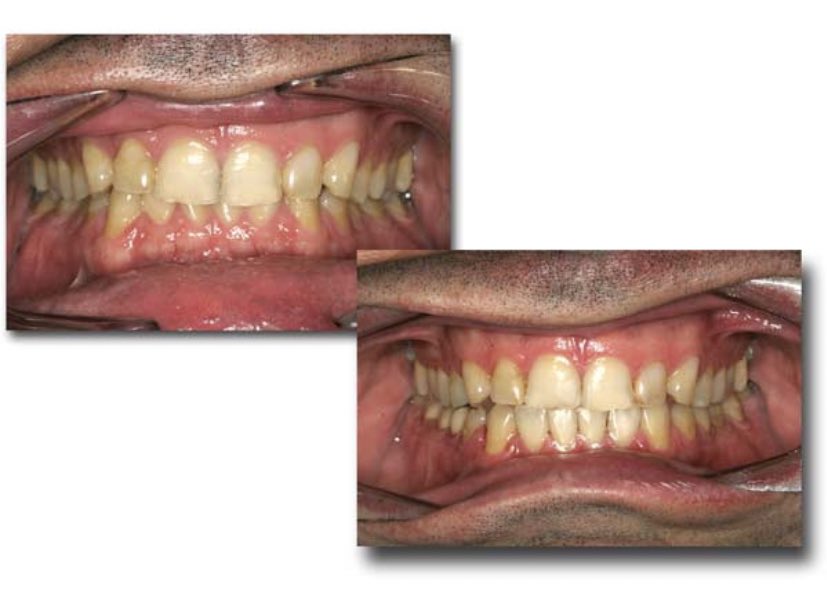 When I say excessively overlap , I mean you can barely see your lower teeth. ( or maybe not at all)As shown in the image below,this patient was overclosed / deep bite. After having his TMJ corrected , his jaw relationship has been fixed and you can see his lower teeth now.