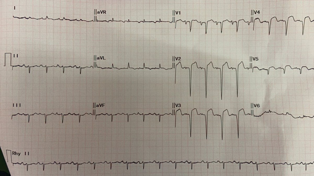 Patient had no chest pain and no symptoms s/o any other angina equivalents. But after getting this ecg, trop T was positive and patient was immediately handed over to the cardiologist. I’m sure people like  @smithECGBlog  @EM_RESUS will be happy after reading this thread.