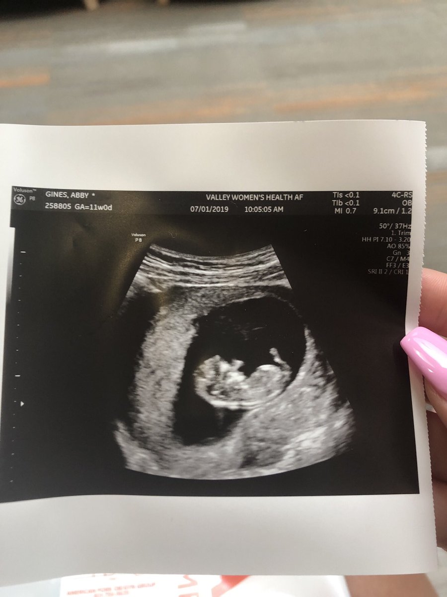 abbygines2's tweet photo. @jdlongoria1 The Ultrasound🌻  The Bump⭐️ The Newborn 💜 Now 🥺🥺 https://t.co/b6Mp3cEy4n