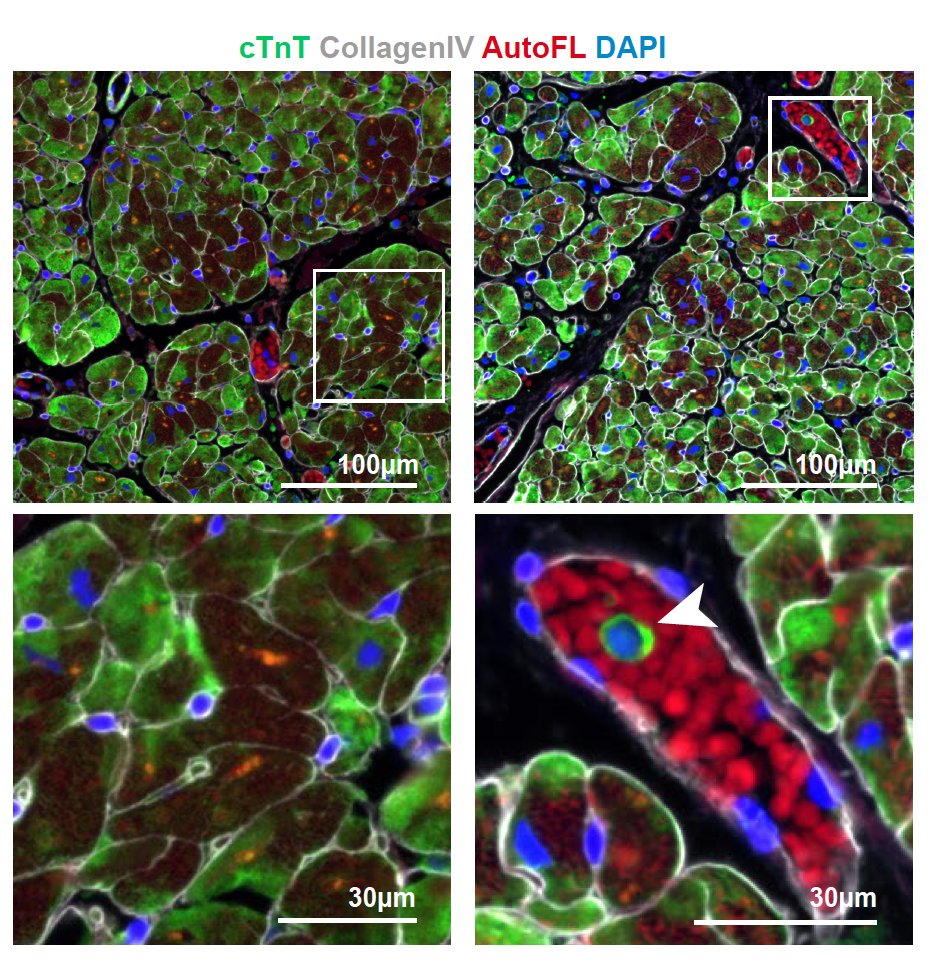 The preprint  https://www.biorxiv.org/content/10.1101/2020.08.25.265561v1 and  @GladstoneInst summary https://gladstone.org/news/new-insights-how-covid-19-causes-heart-damageThis doesn't require intracellular infection for the toxic effects. Interruption of specific transcription speculated, cleavage of A-band 2/