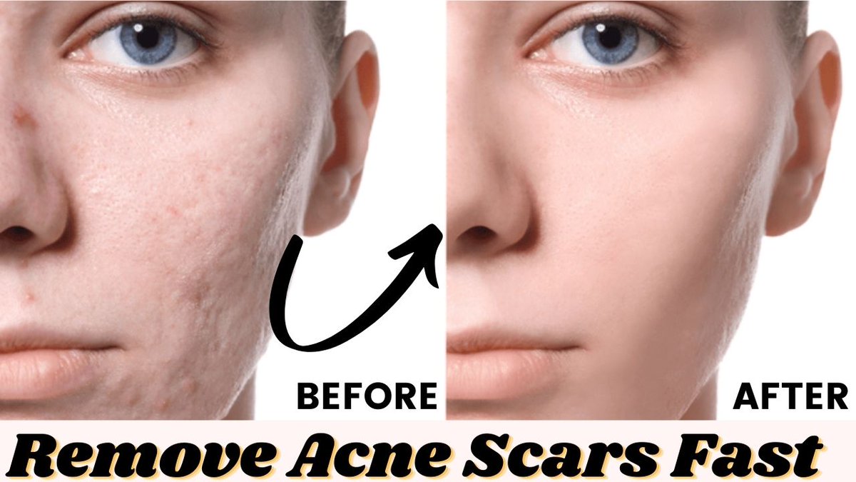 Remedies scars acne to home quickly remove 15 Natural