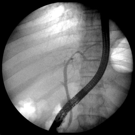 ChetanMittalMD's tweet photo. Post cholecystectomy complete right main duct transection. 
Surgery or Endoscopic / IR guided attempt at re-cannulation ? https://t.co/d8ofC1PS3V