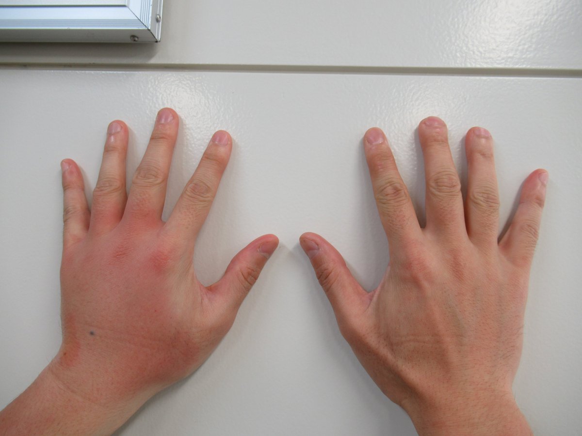 裾花ダム管理事務所 奥裾花ダムです 一昨日鬼無里で うるり と呼ばれるイヨシロオビアブに左手をかまれた のですが 今朝パンパンに腫れ上がってしまいました 特に痛みはないのですが とてもかゆいです だいぶ数は少なくなりましたがまだまだ