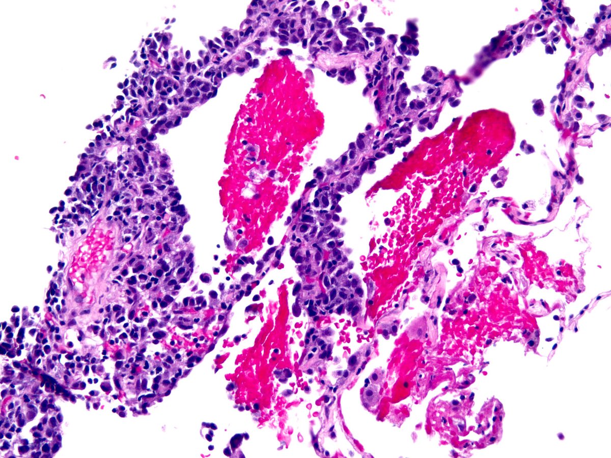 O brave and wise Tweeples is this malignant? Adeno or squamous? Lepidic or not? Lung nodule, core needle biopsy, adult.  #pathology  #pulmpath