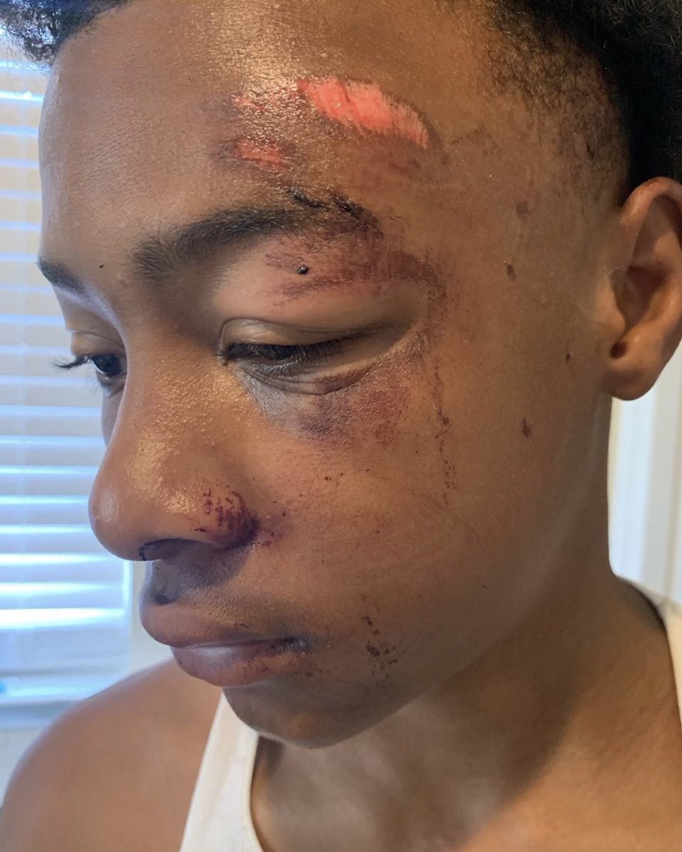 Show me a 13 year old white kid beat like this by the cops. This kid is 13 years old. Officer Kairo according to the victims mom knocked her son unconscious. I need you to read this post by this mother in Jefferson Parish. (Please read each tweet in this thread)