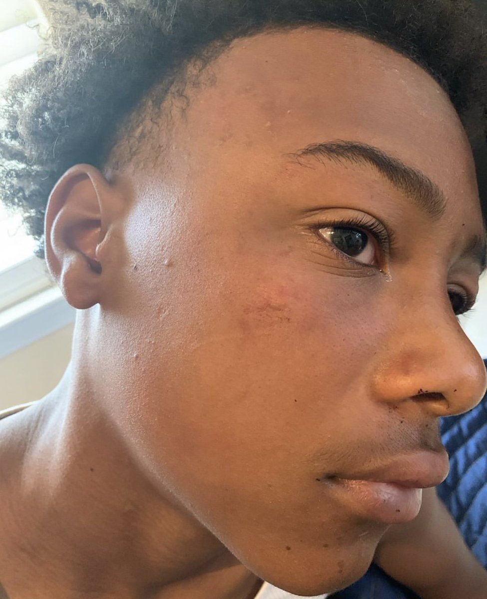 Show me a 13 year old white kid beat like this by the cops. This kid is 13 years old. Officer Kairo according to the victims mom knocked her son unconscious. I need you to read this post by this mother in Jefferson Parish. (Please read each tweet in this thread)