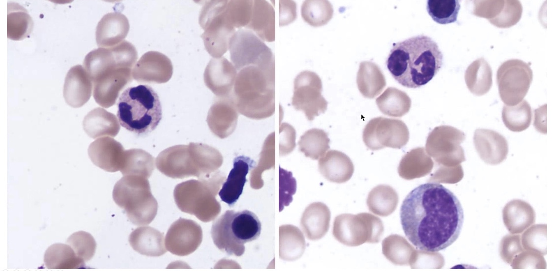 feldstej's tweet photo. #hemepathjc #mmsm #pathtwitter #courtesy #drsalib #medtwitter #leusm #caseimage https://t.co/vv8iOqyYv9