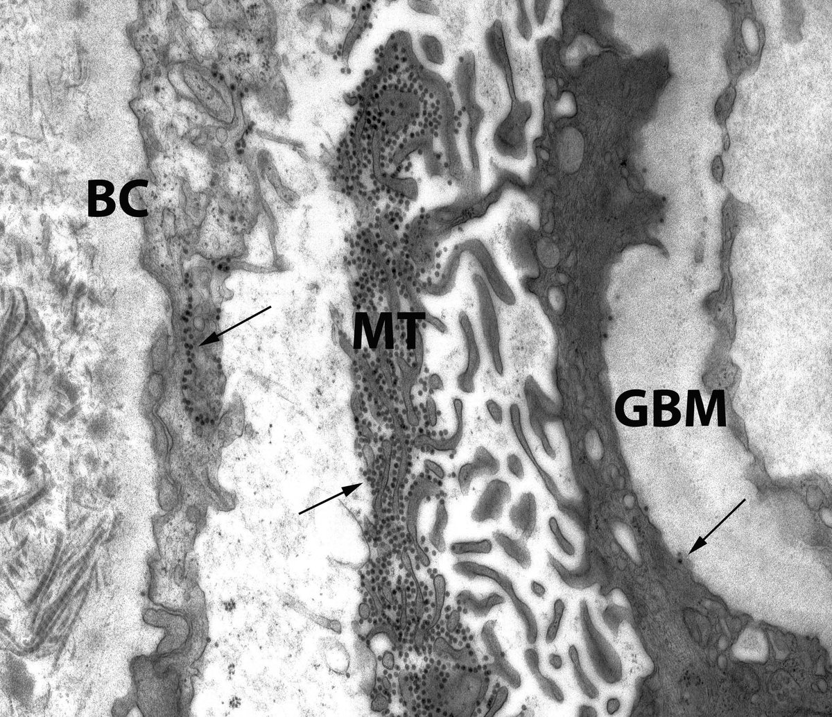 JohnBrealey's tweet photo. @raja_1980 @CandiceRoufosse @ChangUCanSpare @ldcornell @MVankalakunti @ISNeducation @AgnesFogo @renalpathdoc @JZRenalPath @SethiRenalPath @MPAlexanderMD @arvindcanchi @AnjaliSatoskar @arkanalabs @manirath @ErikaBracamo316 Images 1 & 2: arrows indicate BK viruses.
Image 2: BC = Bowman's Capsule, MT = Microvillous Transformation of the Podocyte, GBM = Glomerular Basement Membrane.
Image 3: An intranuclear crystal of many (thousands in 3D) of BK viruses in a tubular cell from the same case. https://t.co/Li49sMgODC