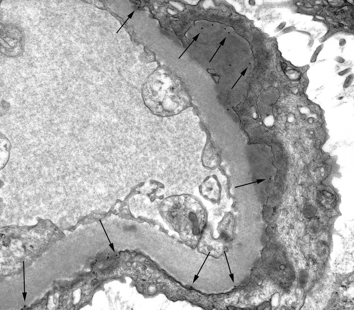 JohnBrealey's tweet photo. @raja_1980 @CandiceRoufosse @ChangUCanSpare @ldcornell @MVankalakunti @ISNeducation @AgnesFogo @renalpathdoc @JZRenalPath @SethiRenalPath @MPAlexanderMD @arvindcanchi @AnjaliSatoskar @arkanalabs @manirath @ErikaBracamo316 Images 1 & 2: arrows indicate BK viruses.
Image 2: BC = Bowman's Capsule, MT = Microvillous Transformation of the Podocyte, GBM = Glomerular Basement Membrane.
Image 3: An intranuclear crystal of many (thousands in 3D) of BK viruses in a tubular cell from the same case. https://t.co/Li49sMgODC