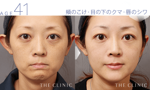 The Clinic ザクリニック エイジング治療 顔の脂肪注入 でお顔のお悩みを解決しませんか こんなお悩みには脂肪注入がおすすめ ほうれい線 目の下のたるみ 目の下のクマ 頬の痩け など 現在 モニターを募集中です 実際に脂肪注入を受けた方