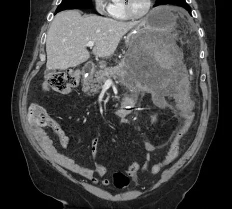 BID_CMRs's tweet photo. #Clinicalquestion
65M PMH obesity p/w #epigastric pain x5d, fevers, WBC 19. Normal LFTs and lipase. #CT below.
What would you do??
#Mediaoftheweek by @AlyssaManciniMD https://t.co/ODdyz8qtQB