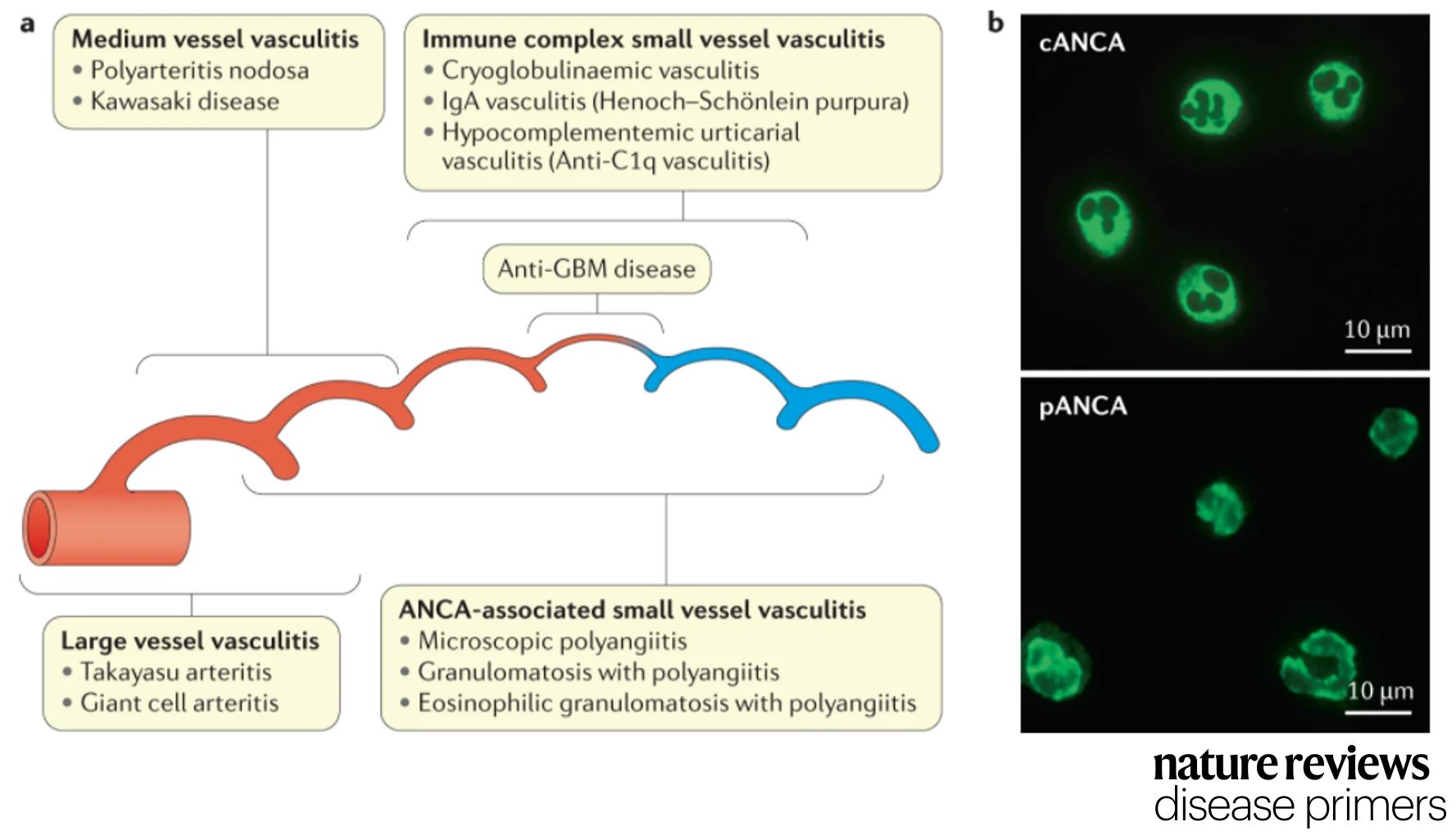 Vasculitis tratamiento natural