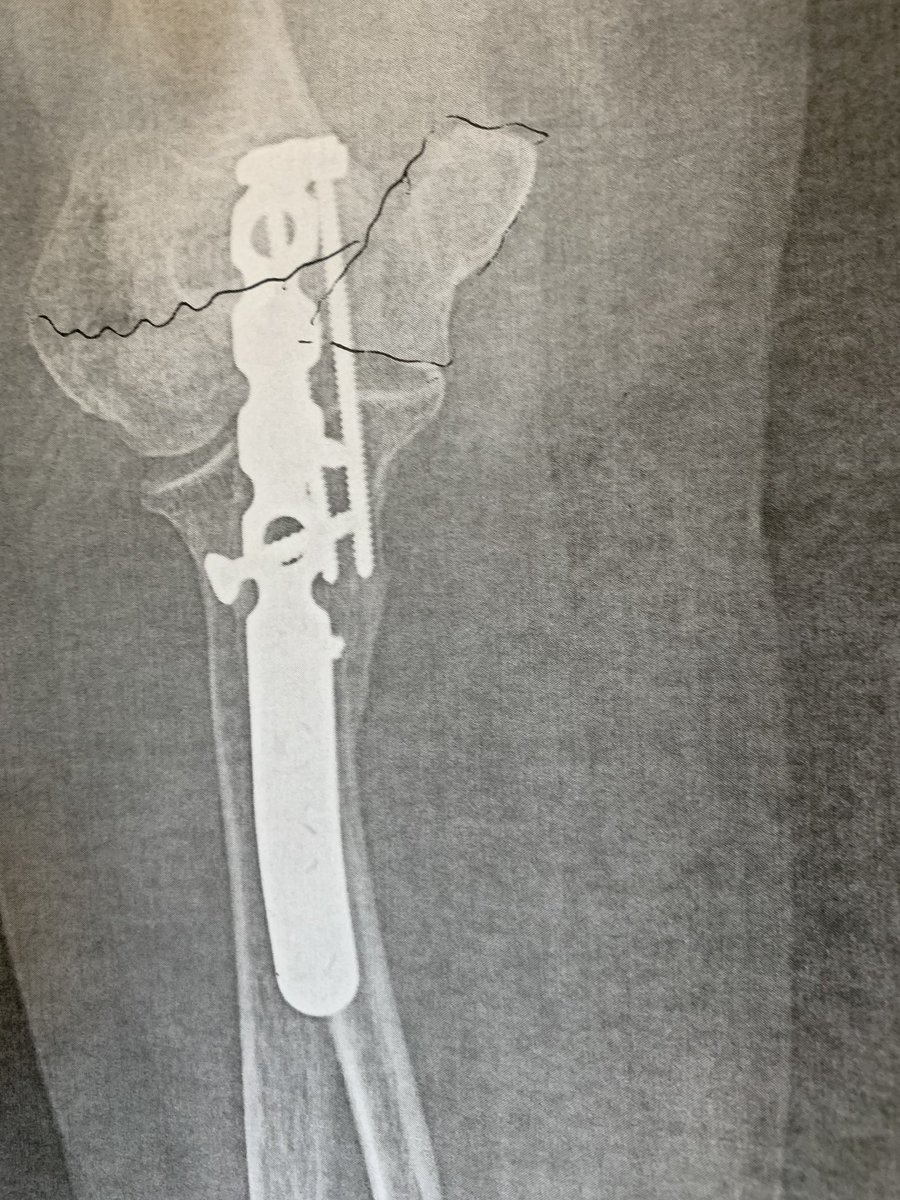 WylieMsw's tweet photo. 🦾😷🤕 Another year.... another bionic part for Mom 🦾🦾🦾 #BionicWoman #BrokenBones #FallRisk #BubbleWrap #NothingLeftToBreak https://t.co/inV9hxItKn
