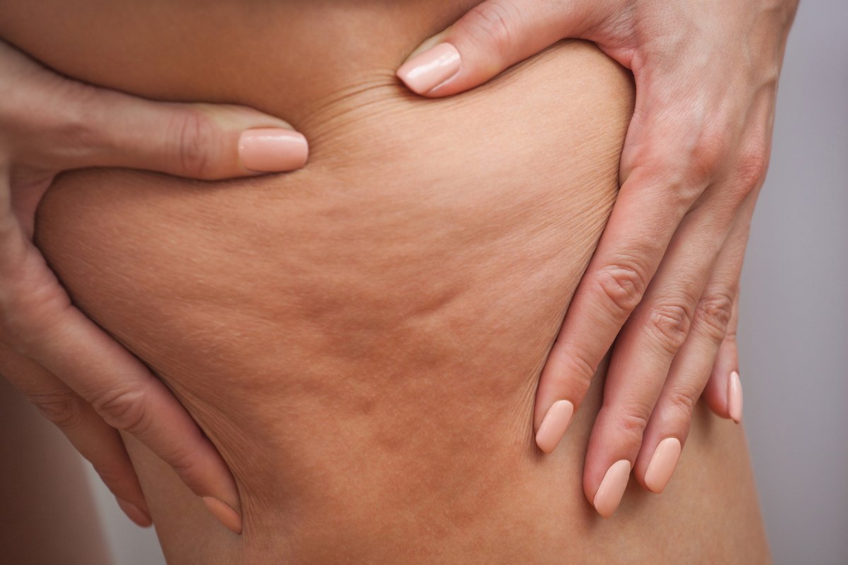 EndoSystems's tweet photo. The 5 Biggest Myths About Cellulite Debunked https://t.co/Wn60iFDe6Z https://t.co/rcVaLSj5ar