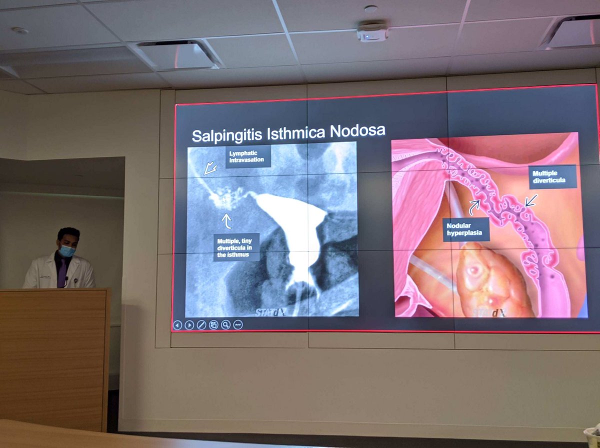 Cleveland Clinic Diagnostic Radiology Residents (@clinicradiology) on Twitter photo Great job, <a href="/BrianXavierMD/">Brian Xavier</a> on your interesting case conference presentation! So helpful to refresh on HSG pathology 🙌🙌🙌
#radres #MedTwitter Great job, <a href="/BrianXavierMD/">Brian Xavier</a> on your interesting case conference presentation! So helpful to refresh on HSG pathology 🙌🙌🙌
#radres #MedTwitter