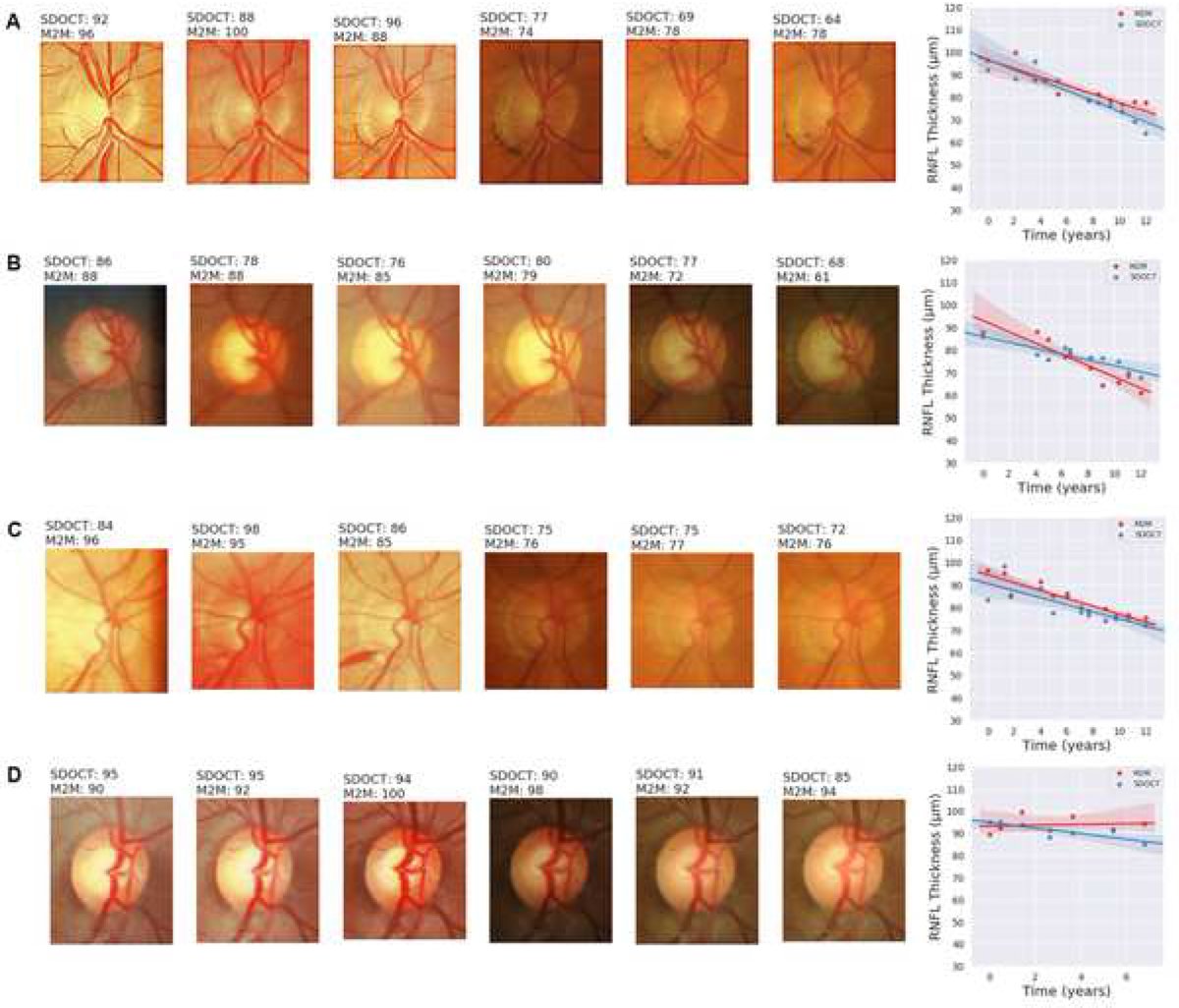 Detection of progressive glaucomatous optic nerve damage on fundus photographs with deep learning. #AI #ophthalmology #glaucoma <a href="/dukeeyecenter/">Duke Eye Center</a> <a href="/vipduke/">Russell</a> ow.ly/v1Z950APcqL