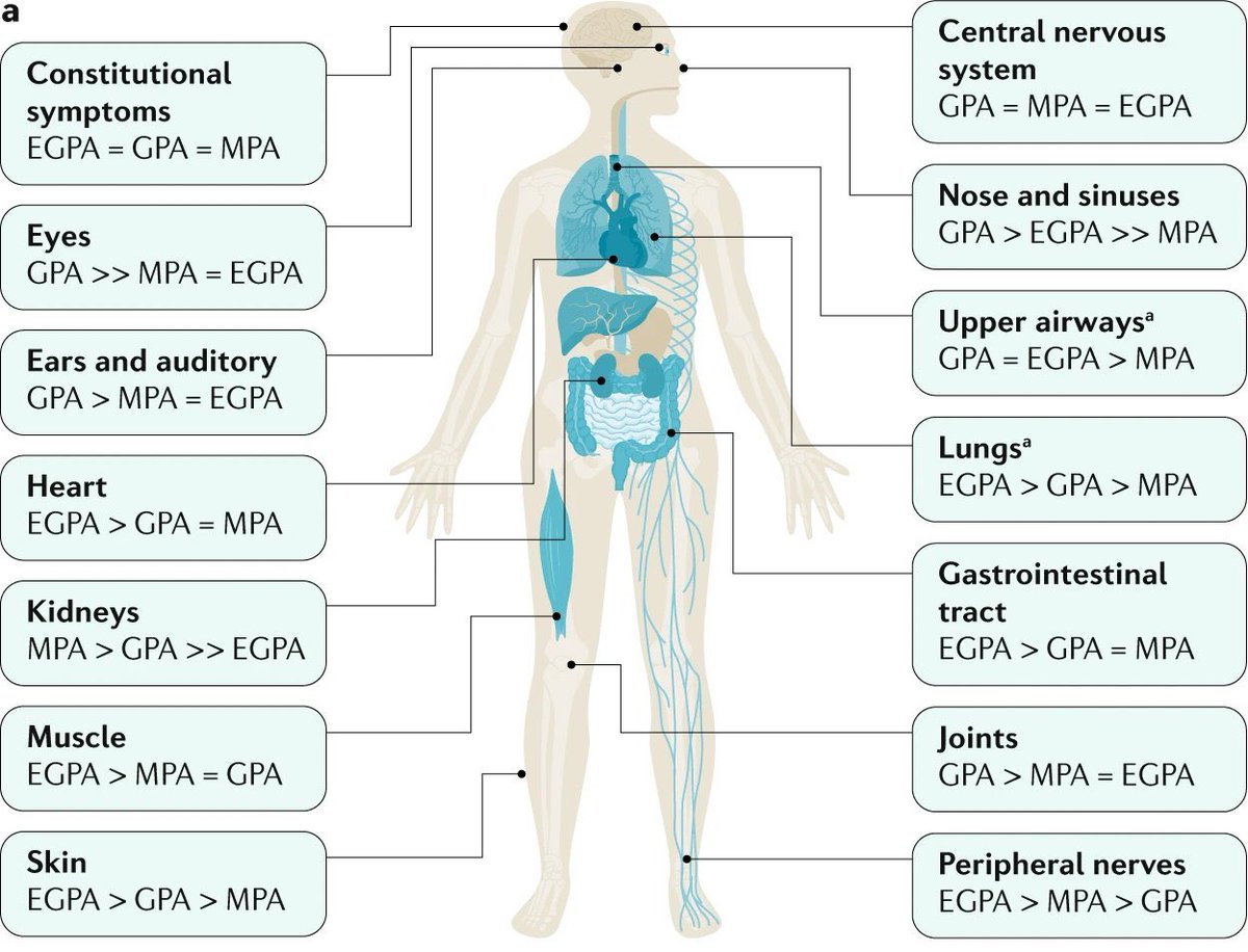 Fantástica revisión de vasculitis ANCA en @DiseasePrimers de @KitchingLab et al. Os dejo el artículo en acceso abierto 🔓 nature.com/articles/s4157…