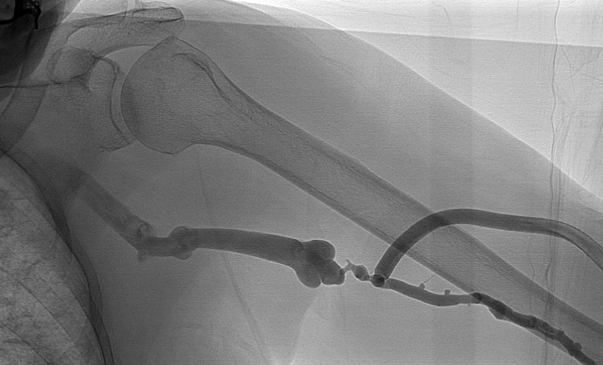 urmed_ir's tweet photo. Nothing like a quick AVF tune up on a Friday. #AllAboutThatWaist 

#InnovationToHeal #BasicIR #Irad #TwittIR https://t.co/5qr3y0cbYi