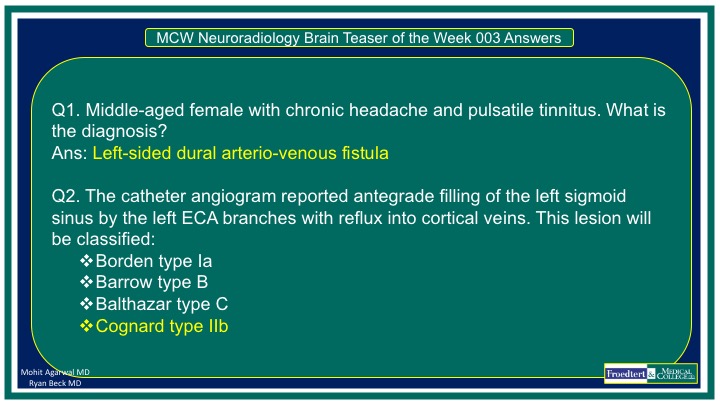 PublishedXPrime's tweet photo. #MCWNeuroradBTW 003 Ans: Dural AVF

Check out 👇🏻 short video:
https://t.co/3DFJAA8oXo

Big thanks to Dr Ryan Beck for the case &amp; to those who participated 

@RGovindiah @Jaswal_Shama @bdoop3210 @DhruvPatel1502 @DaniaBukhari 
  
#FOAMed #FOAMrad #radres #MedEd #RadEd #neurotwitter https://t.co/2IR6RvJyla
