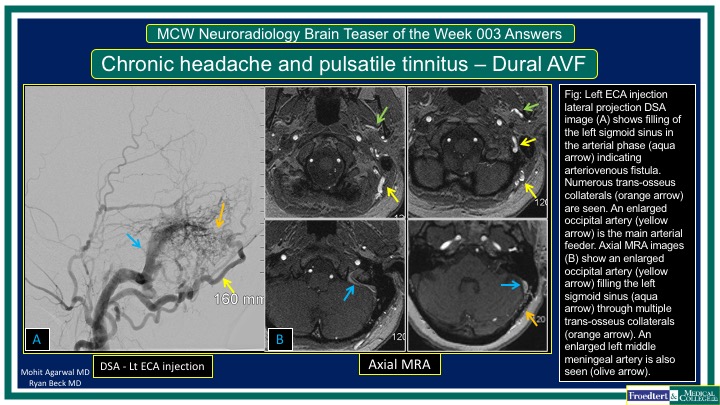 PublishedXPrime's tweet photo. #MCWNeuroradBTW 003 Ans: Dural AVF

Check out 👇🏻 short video:
https://t.co/3DFJAA8oXo

Big thanks to Dr Ryan Beck for the case &amp; to those who participated 

@RGovindiah @Jaswal_Shama @bdoop3210 @DhruvPatel1502 @DaniaBukhari 
  
#FOAMed #FOAMrad #radres #MedEd #RadEd #neurotwitter https://t.co/2IR6RvJyla