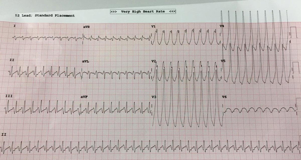 JamesCranley's tweet photo. OK hivemind, what's the rhythm? Can you do better than the ECG machine diagnosis?

How would you treat?

Middle aged patient. No previous heart disease. Presyncopal with palpitations. #EPeeps #ItsNotWrong #CardioEd https://t.co/8IkCBt1H2s