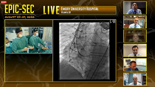 AIU_Medical's tweet photo. Great #EPICSEC so far! Special thanks @habib_samady, William Nicholson MD, Jaikirshan Khatri MD & @wissamj123 for detailing ASAHI Gladius Mongo & the new Gaia Next series wires. Learn more about our newest technologyโDM us or contact your local rep.
#GladiusMongo #GaiaNext https://t.co/GxcXYnrSiz