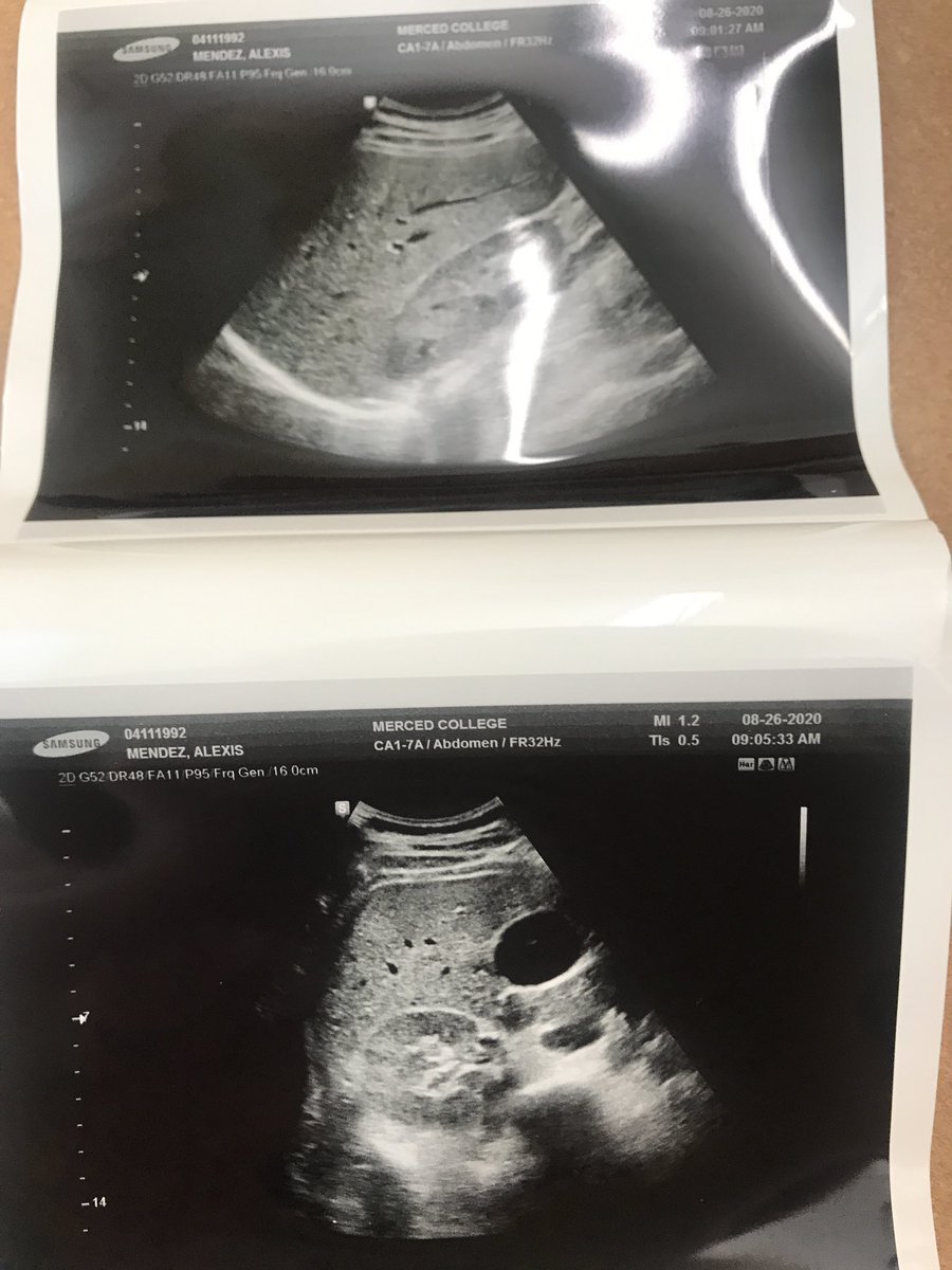 Quick update : my scans were beautiful 💕 #FutureSonographer #UltrasoundStudent