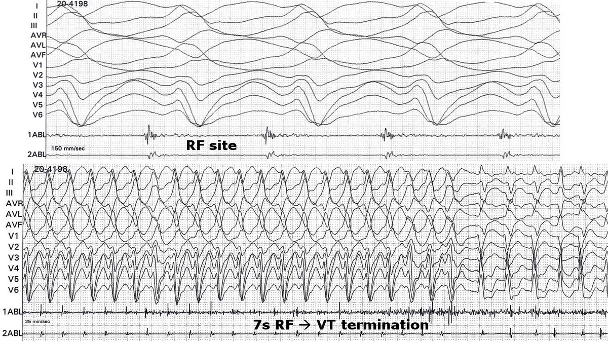 messapus's tweet photo. 60M, previous MI (1st diagonal culprit), severe LV dysfunction, ICD: incessant, drug refractory monomorphic VT quickly gone with @RFablation, after key HD mapping. No need for fluoroscopy. #NoXRay #ablateVT #Epeeps #cardiotwitter @sozi81 @DrRoderickTung More tracings to follow. https://t.co/A0RsCSc5jJ