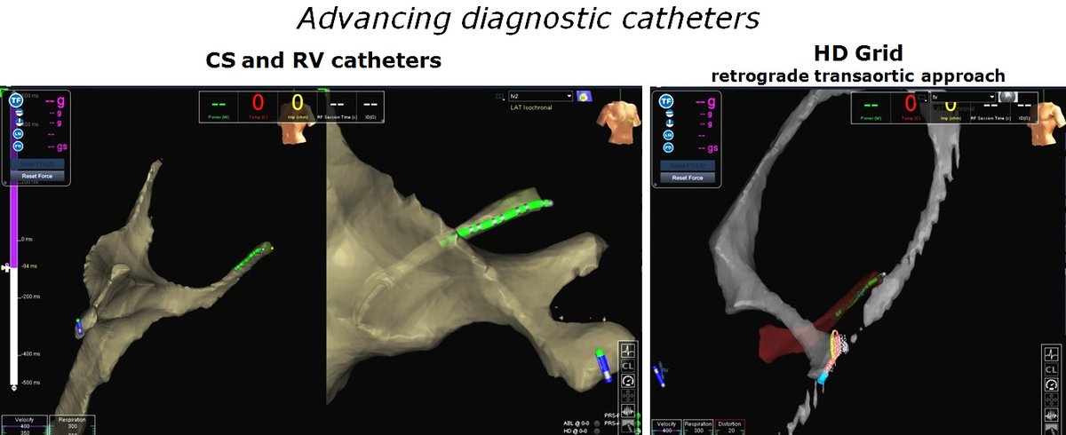 messapus's tweet photo. 60M, previous MI (1st diagonal culprit), severe LV dysfunction, ICD: incessant, drug refractory monomorphic VT quickly gone with @RFablation, after key HD mapping. No need for fluoroscopy. #NoXRay #ablateVT #Epeeps #cardiotwitter @sozi81 @DrRoderickTung More tracings to follow. https://t.co/A0RsCSc5jJ