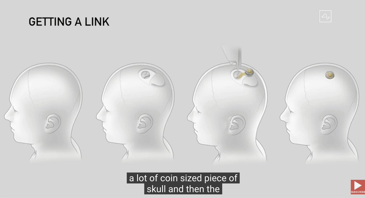 Brain implanted chips sound really exciting, except for that 3rd step.