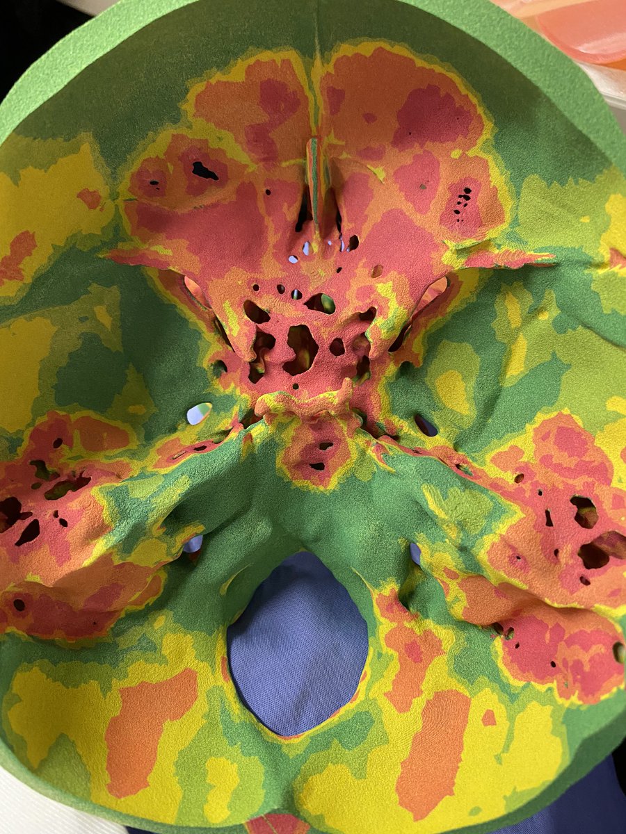 Our <a href="/mayoclinic/">Mayo Clinic</a>  #plasticsurgery team is often tasked w/ reconstructing the face from #cancer #trauma &amp; #congenital lesions . Patient specific #3Dprinted maps showing bone thickness aids in customized surgical approaches to help #patients feel normal again. <a href="/MaterialiseNV/">Materialise</a> <a href="/HP/">HP</a>