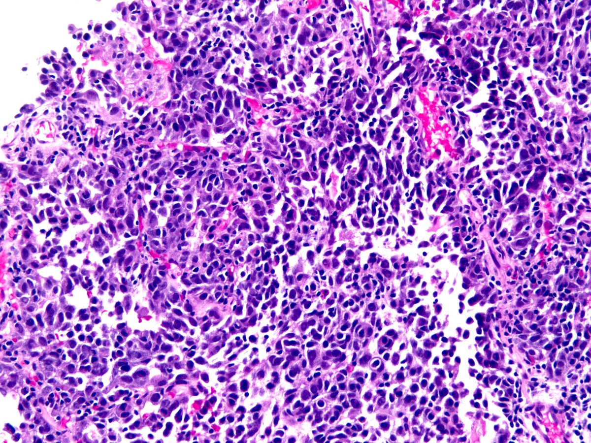 Correct answer: melanoma This lepidic pattern was very focal but is strikingly highlighted by the SOX-10  #ihcpath (see pic). Diagnosis was not hard (h/o melanoma). The other 2 pics are rest of tumor (H&E and SOX-10). Kudos to  @Path_Matt and others for guessing this correctly!