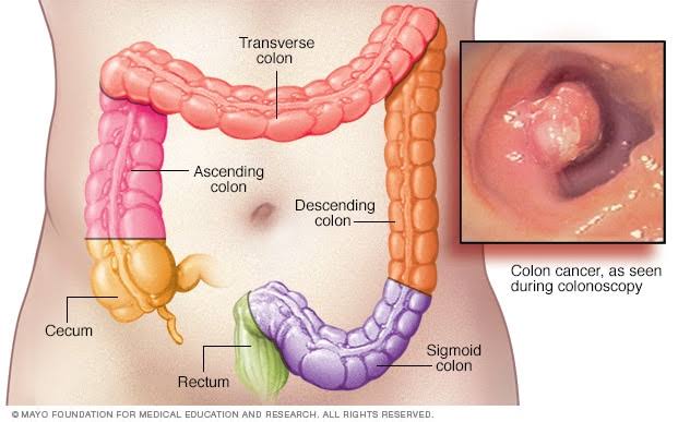 the Large Intestine, which plays an important role in the body being able to remove waste products i.e faeces."Colorectal Cancer is the cancer of the colon and rectum"- The cells of the colon and rectum grows out of normal with no control forming masses called "TUMORS"
