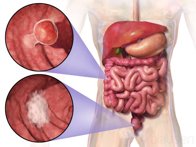 the Large Intestine, which plays an important role in the body being able to remove waste products i.e faeces."Colorectal Cancer is the cancer of the colon and rectum"- The cells of the colon and rectum grows out of normal with no control forming masses called "TUMORS"