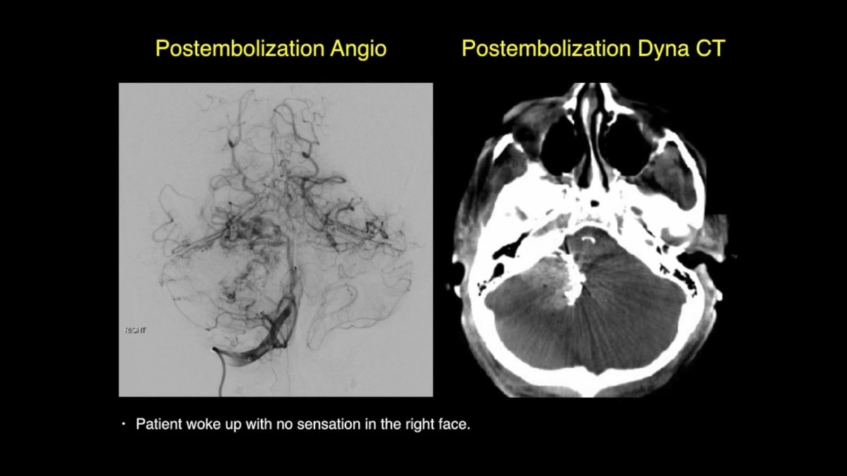 DrBaskaya's tweet image. 39y M #hemangioblastoma embolized with #onyx, woke up with no sensation in R face, DWI: small restricted diffusion within R superior cerebellar vermis, GTR was uneventful, extruded onyx on #trigeminal nerve &amp;amp; #brainstem was not removed 
youtu.be/s0DjD26Xkas
#nsgy #microsurgery